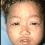 Child in later stages, 4 or 5 days, of measles rash.