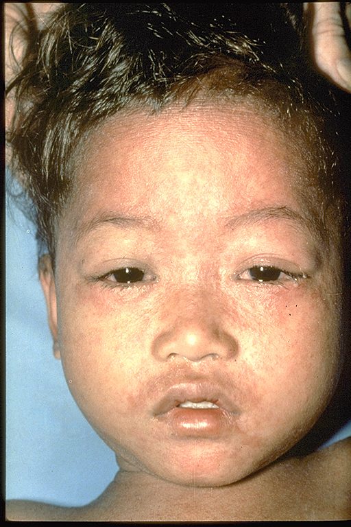 Child in later stages, 4 or 5 days, of measles rash.