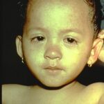 Young boy in the later stages of measles rash.