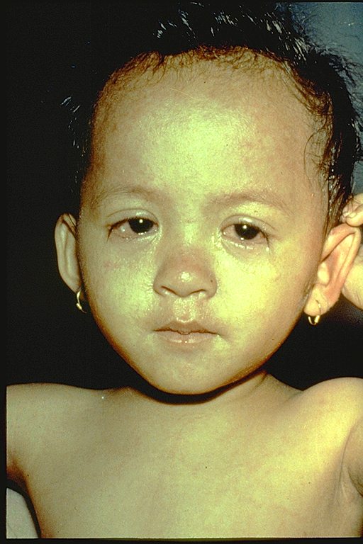 Young boy in the later stages of measles rash.