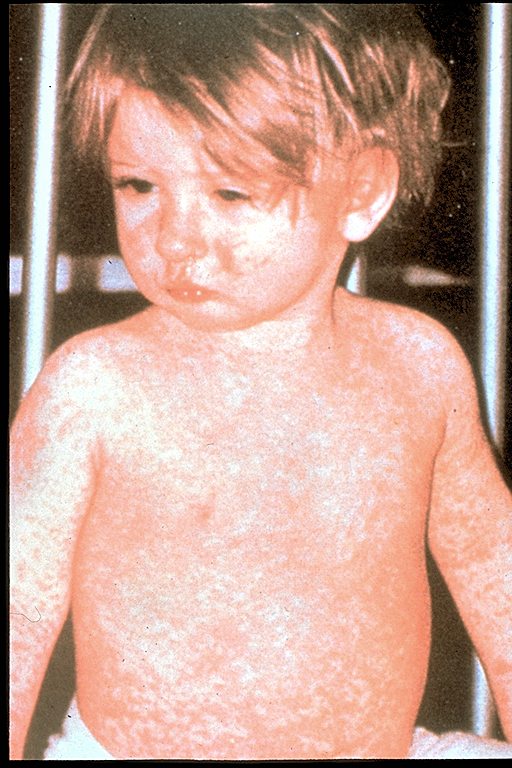 The measles rash covers this child's arms and stomach.