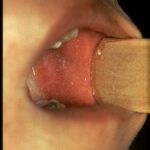 White spots in a child's mouth are common with measles.