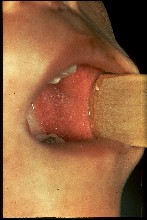 White spots in a child's mouth are common with measles.