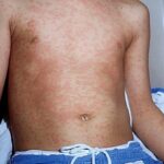 The chest of a child with measles.