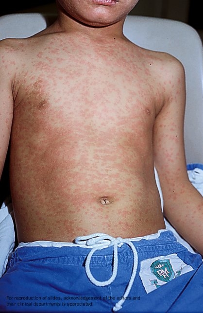 The chest of a child with measles.