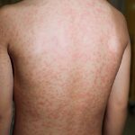 The back of a child with measles.