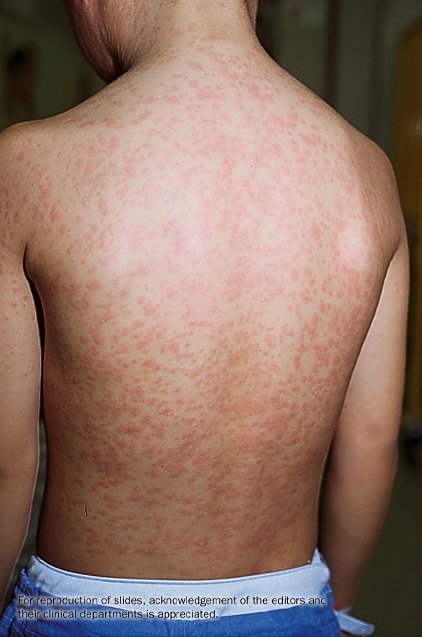 The back of a child with measles.