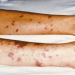 The legs of a young child showing epticemic rash.