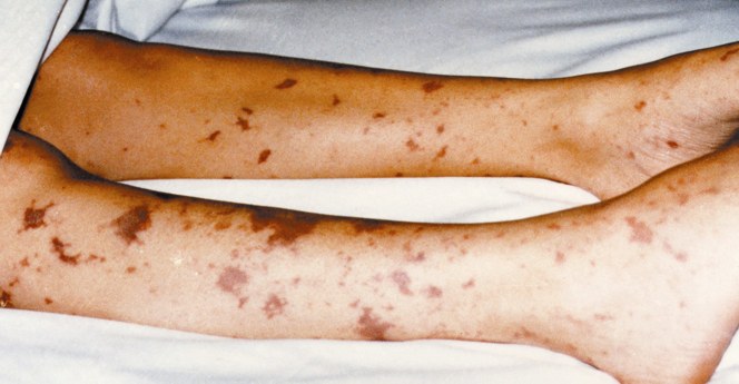 The legs of a young child showing epticemic rash.