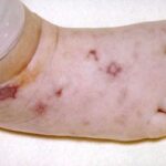 A foot showing the characteristic angular, necrotic lesions on the foot of an infant with meningococcemia.