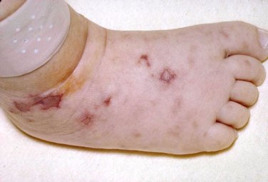 A foot showing the characteristic angular, necrotic lesions on the foot of an infant with meningococcemia.