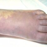 The left foot of an adolescent female with marked purpura.