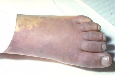 The left foot of an adolescent female with marked purpura.