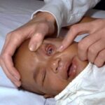 A doctor examining the left eye of an infant with meningococcal endophthalmitis