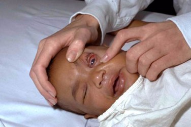 A doctor examining the left eye of an infant with meningococcal endophthalmitis