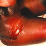 The foot of a four-month-old female with gangrene of feet due to meningococcemia.