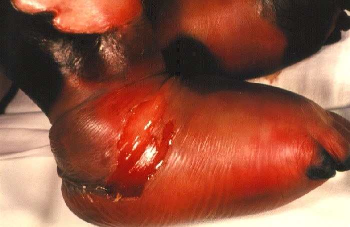 The foot of a four-month-old female with gangrene of feet due to meningococcemia.