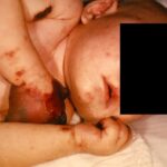 Four-month-old female with gangrene of hands on her arms and hands due to meningococcemia.