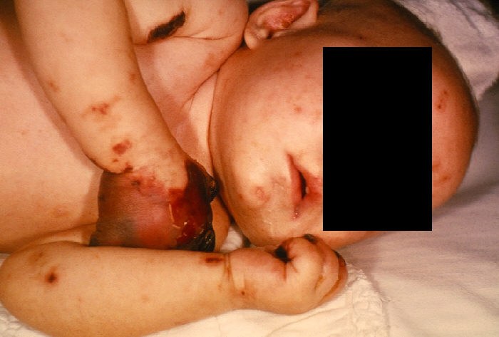 Four-month-old female with gangrene of hands on her arms and hands due to meningococcemia.