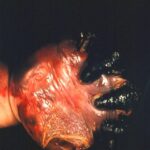 The hand of a four-month-old female with gangrene of hand due to meningococcemia.
