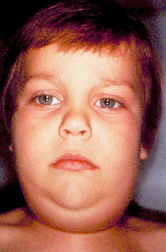 Child with mumps, showing enlarged neck area.