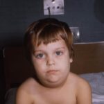 Child's face displaying diffuse lymphedema of the neck due to a mumps virus infection of the parotid salivary glands.