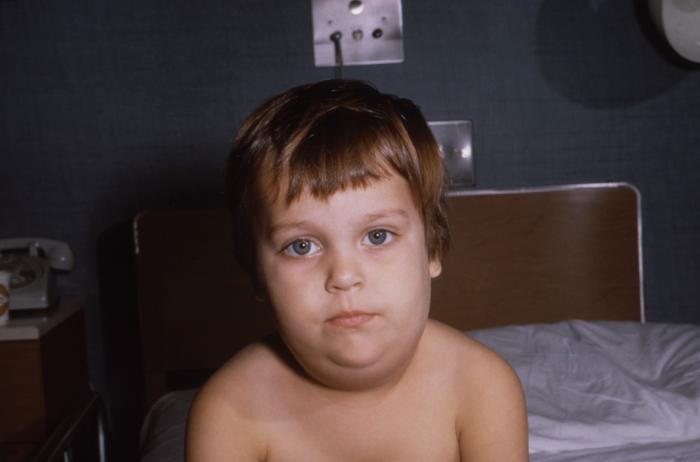 Child's face displaying diffuse lymphedema of the neck due to a mumps virus infection of the parotid salivary glands.