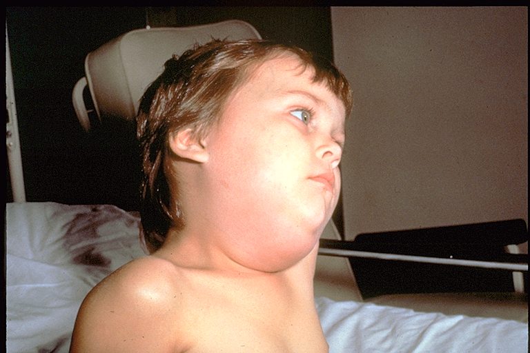 Child very swollen under the jaw and in the cheeks due to mumps.