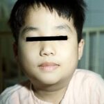 A child with mumps, his eyes blocked out for privacy.