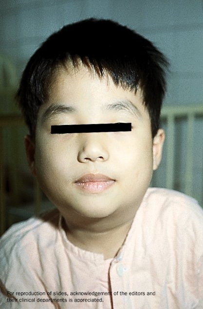 A child with mumps, his eyes blocked out for privacy.