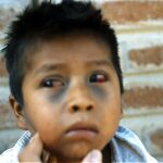 Child with broken blood vessels in eyes and bruising on face due to pertussis coughing.