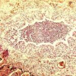 Bronchiolar plugging in neonate with pertussis pneumonia.