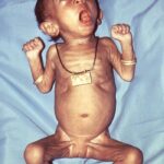 Female infant with pertussis.