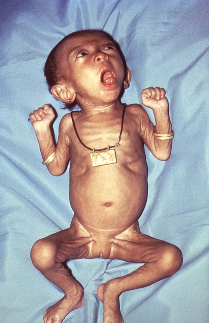 Female infant with pertussis.