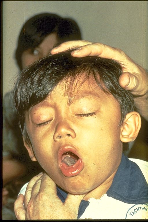 Child with pertussis having difficulties with coughing and getting enough air.
