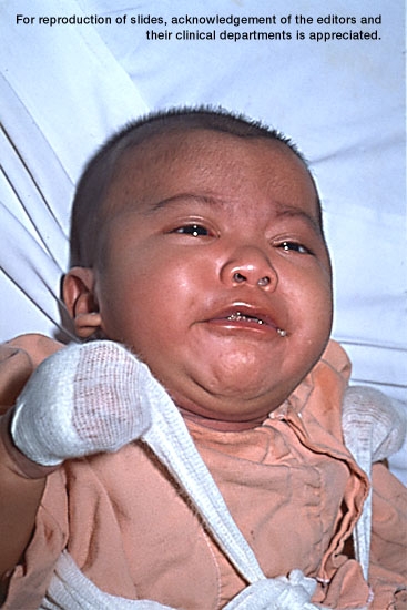 Infant with pertussis, third in a sequence.