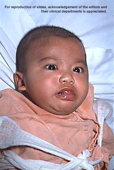 Infant with pertussis, second in a sequence.