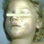Very pale child with pneumococcal disease.