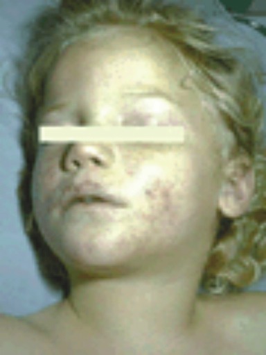 Very pale child with pneumococcal disease.