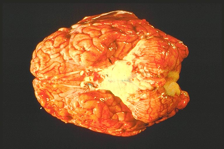 Brain of a person who died from pneumococcal brain infection.