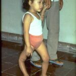 Child with a severely deformed leg due to polio, walking hand-in-hand with an adult.