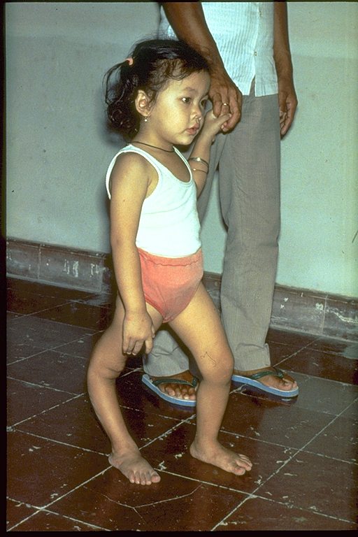 Child with a severely deformed leg due to polio, walking hand-in-hand with an adult.