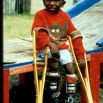 A young male child with crutches as a result of polio.