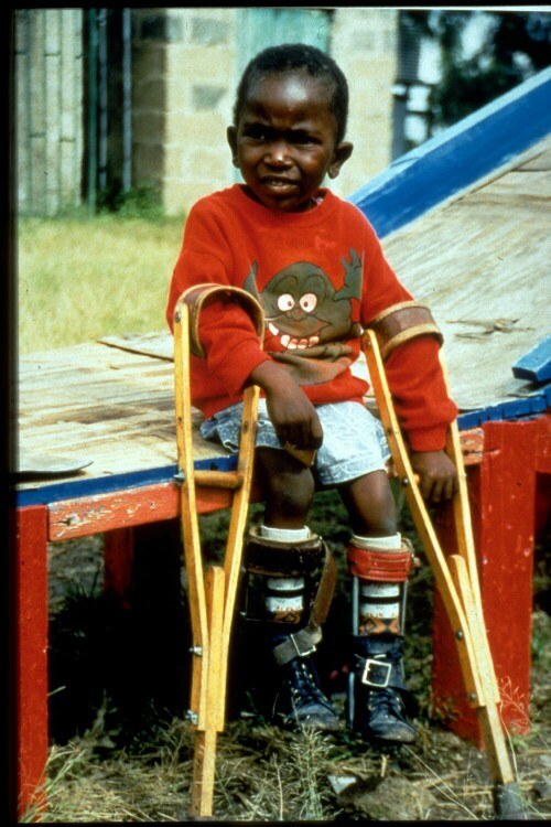 A young male child with crutches as a result of polio.