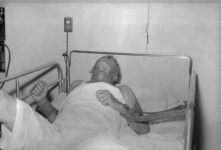 Hospitalized human rabies victim in restraints in a hospital bed.