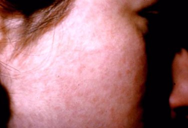 Rubella facial rash on the high cheek of a woman.