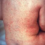 Rubella rash on seated child's back.