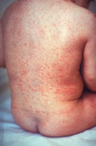 Rubella rash on seated child's back.