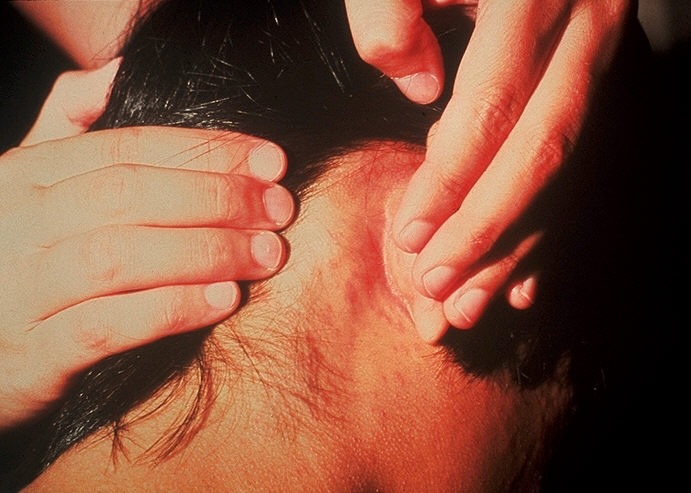 Two hands pulling back a man's hair to show rubella rash behind his ear..