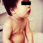 An 11-month-old infant with mild rubella rash on neck, torso.